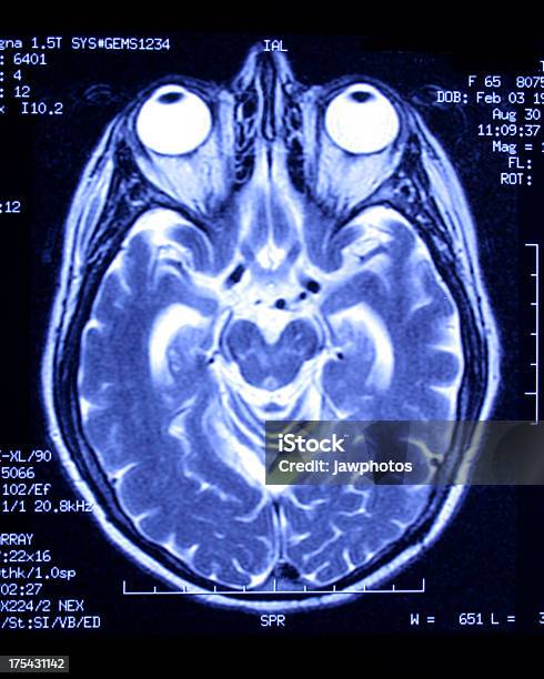 Top Kopf Xray Stockfoto und mehr Bilder von Magnetresonanztomographie - Magnetresonanztomographie, Auge, Tod