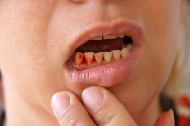 Person holding their lip down to show their bleeding gums stock photo