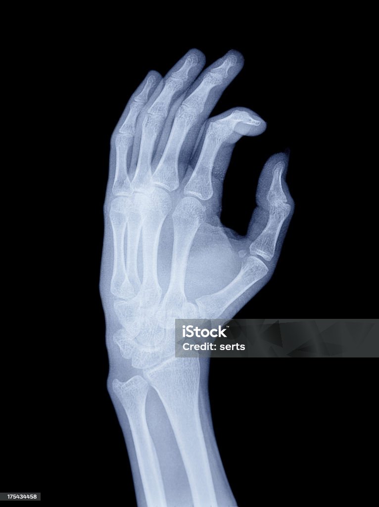 Una radiografia della mano - Foto stock royalty-free di Anatomia umana