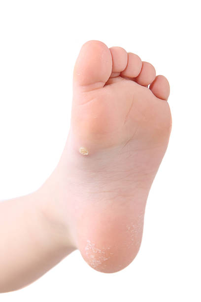 Photo of a plantar wart on a child's foot  stock photo