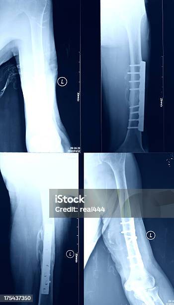 Xray 骨折 - X線撮影のストックフォトや画像を多数ご用意 - X線撮影, クローズアップ, データ