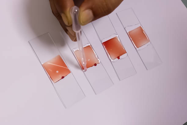 istock Technician preparing blood smear for sickling test to diagnosed Sickle cell anemia, Sickle cell disease (SCD). 1754423517