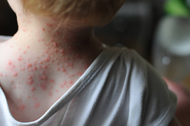 Chicken pox A two year old boy with chicken pox. Day 2. pox stock pictures, royalty-free photos & images