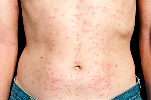 Bumps on human skin after exposure to contaminated hot tub; Hot Tub Folliculitis