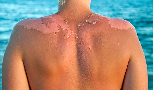 Skin peeling Peeling sunburned back leaf epidermis stock pictures, royalty-free photos & images