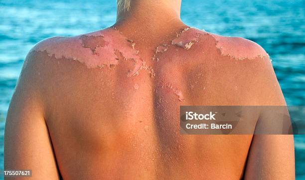 Skin Peeling Stock Photo - Download Image Now - Sunburned, Sun, Sunlight