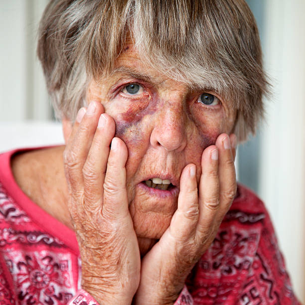 istock Battered senior woman with bruises 175514229