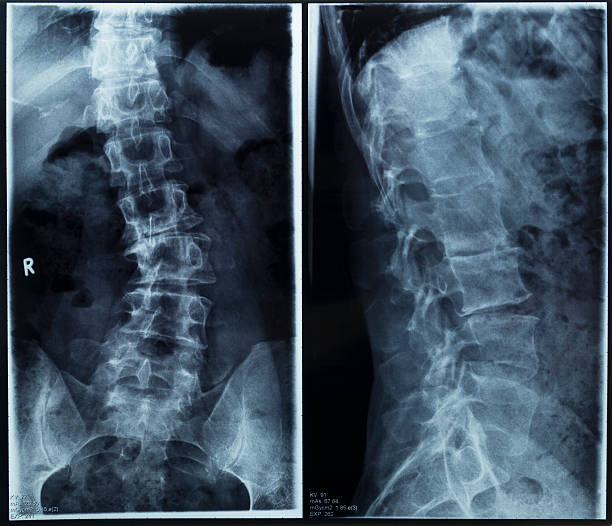 degenerative 脊柱側弯症 - scoliosis ストックフォトと画像