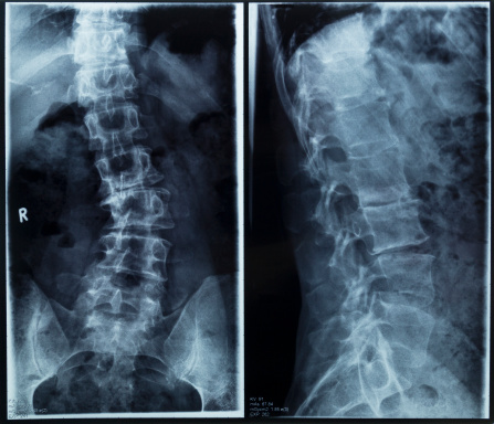 Severe degenerative scoliosis due to multiple disc prolaps on digital x-ray of the spine.
