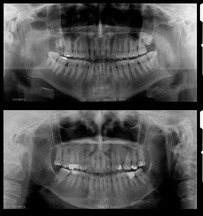 Panaromic dental Xray