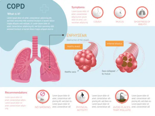 Vector illustration of Infographic on chronic obstructive pulmonary disease, COPD,