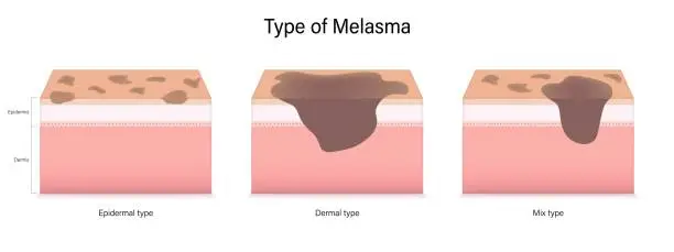 Vector illustration of Type of melasma vector. Epidermal, Dermal and mix type. Facial skin problems.