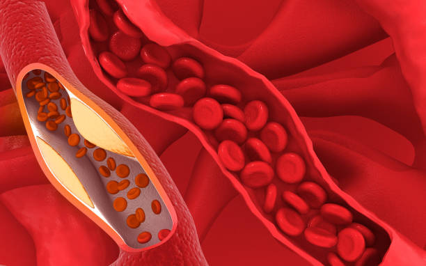istock Clogged arteries on scientific background 1755617134