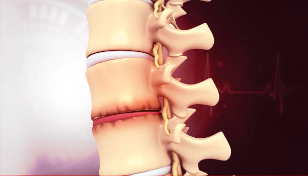 istock Human spine disc bulging. Disc pain 1755618475