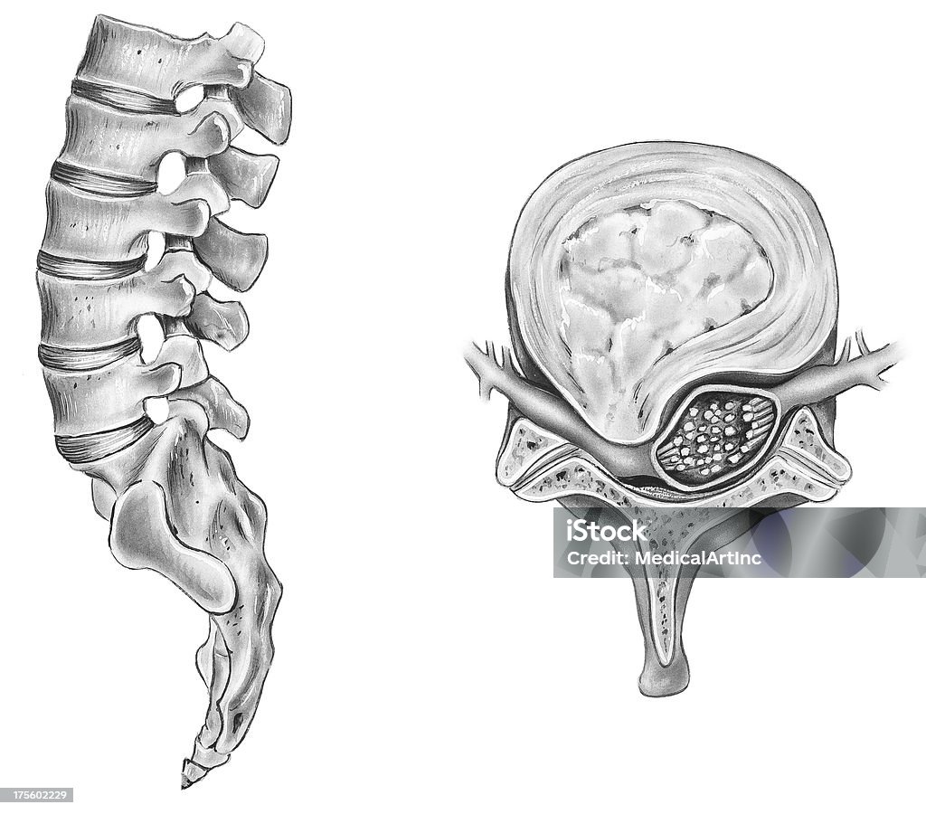 脊椎-Ruptured Intervertebral ディスク - 椎間板のロイヤリティフリーストックイラストレーション