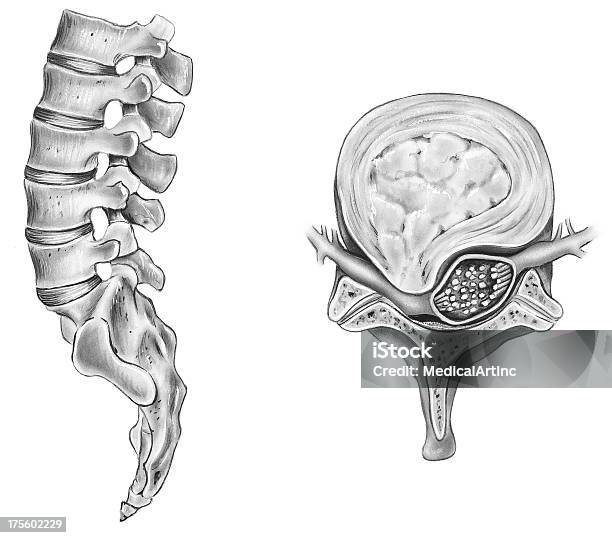 脊椎ruptured Intervertebral ディスク - 椎間板のベクターアート素材や画像を多数ご用意 - 椎間板, 背痛, 人体構造