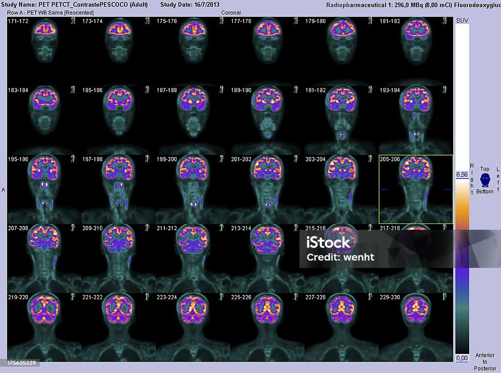 Animal de estimação-TAC coronal Tomografia do cérebro - Royalty-free Cérebro Foto de stock