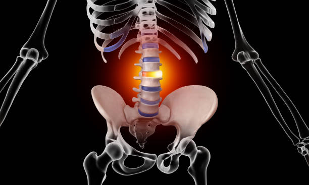 istock Lumbar disc injury skeleton view 1756631594