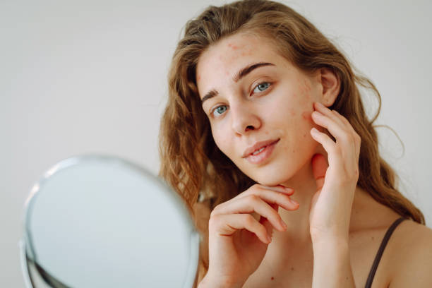 istock Cute woman with rashes on her face looks into a small mirror. 1756636230