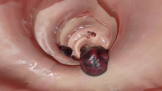 Bowel cancer or Colorectal tumor, Colon cancer, intestine inflammatory bowel Disease, intestine pain, celiac, infections, duplicating, cells expanding, malignant cancerous, viruses, 3d render