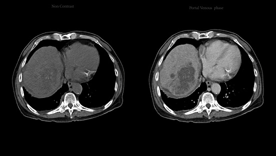 CT upper abdomen axial view  NC, A phase , V phase and delayed phase DDX is atypical HCC or hepatocellular carcinoma.