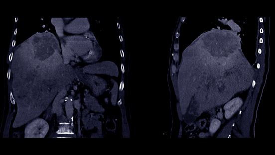 CT upper abdomen coronal and sagittal view showing  DDX is atypical HCC or hepatocellular carcinoma.