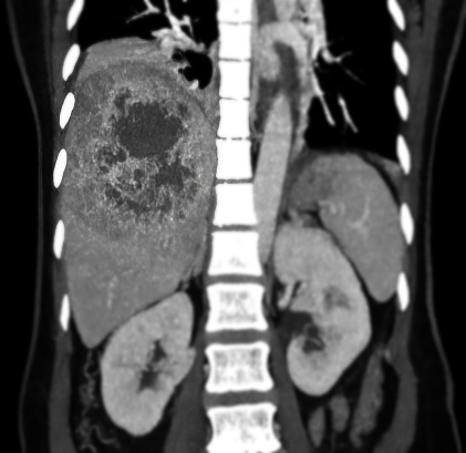 CT upper abdomen coronal view showing  DDX is atypical HCC or hepatocellular carcinoma.