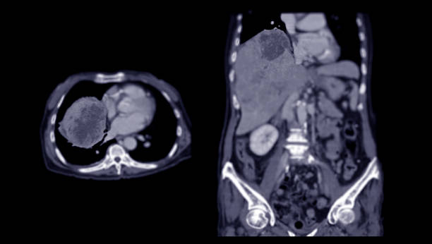 istock CT upper abdomen DDX is atypical HCC or hepatocellular carcinoma. 1757153400