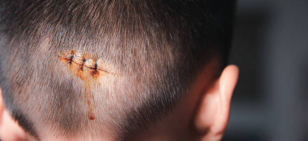 The lacerated suture wound of head which suture by nylion suture about 3 stitches The lacerated sutured wound of kid back head which suture by nylon suture about 3 stitches at the emergency room of the hospital, Medical care of the surgery lesion on the head, children of Accident stitches wound surgery nurse stock pictures, royalty-free photos & images