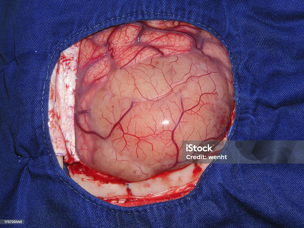 양성 뇌종양 - 로열티 프리 뇌전증 스톡 사진
