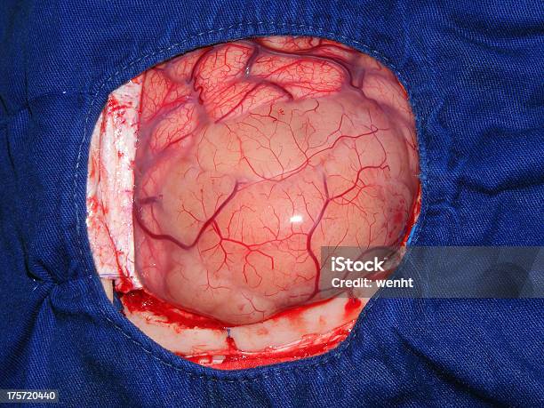 Tumor Benigno No Cérebro - Fotografias de stock e mais imagens de Cirurgia - Cirurgia, Epilepsia, Tumor cerebral