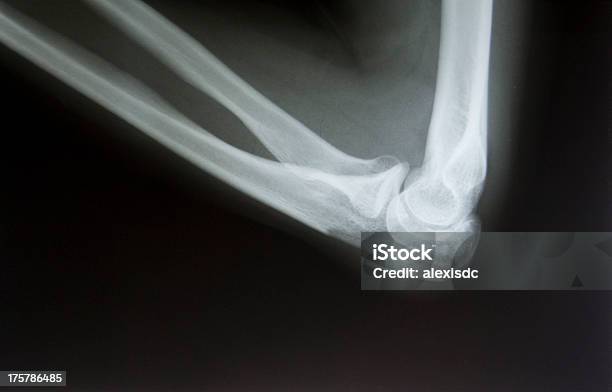 Broken Ellenbogen Xray Bild Stockfoto und mehr Bilder von Armknochen - Armknochen, Beleuchtet, Beschädigt