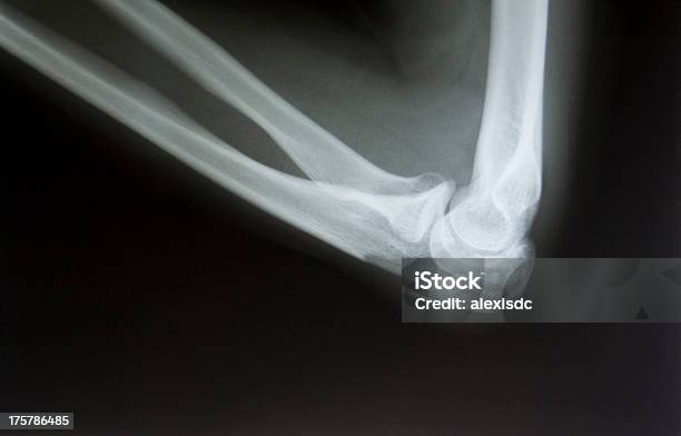 Foto de Broken Cotovelo Imagem De Raios X e mais fotos de stock de Articulação humana - Articulação humana, Braço Quebrado, Braço humano