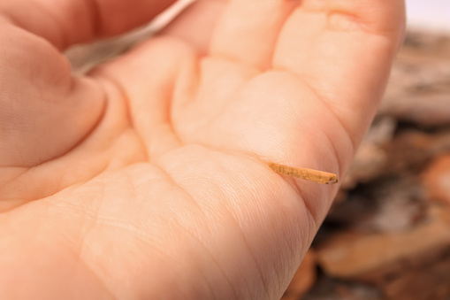 Woman with splinter in her hand on blurred background, closeup