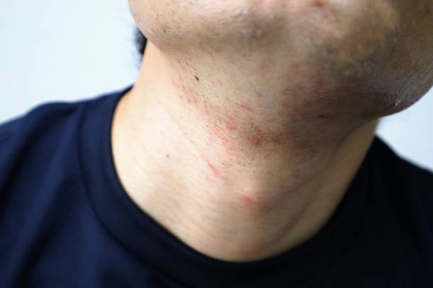istock A person with rough skin after shaving 1758923562