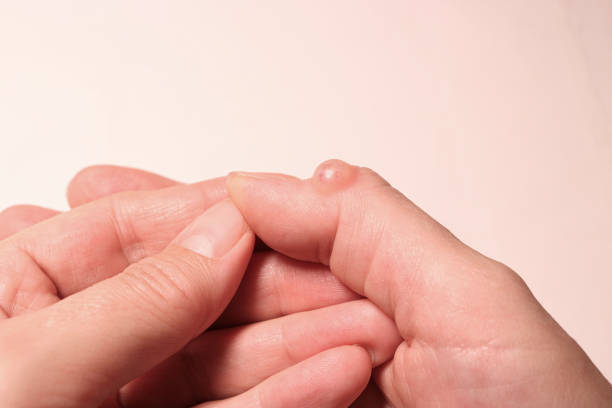 ženská ruka s hygromem palce. selektivní zaostření. - ganglion - stock snímky, obrázky a fotky