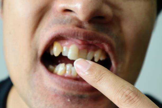istock Close-up of a person with misaligned teeth 1759000334
