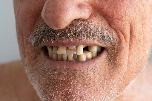 Smile With Missing Tooth.Broken Tooth Absence