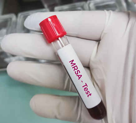 Mrsa Lab Machine Blood Sample For Mrsa Screening Test Bacterial Infection That Is ...