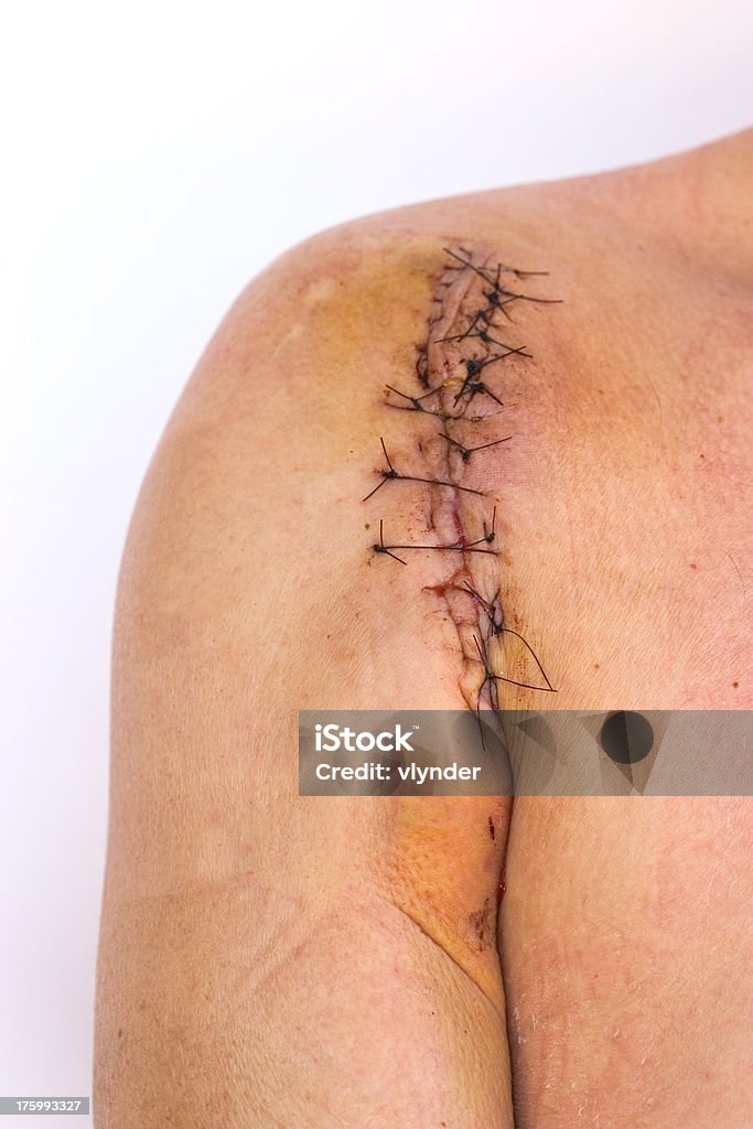 Stiched cicatrice sulla spalla - Foto stock royalty-free di Bruttezza