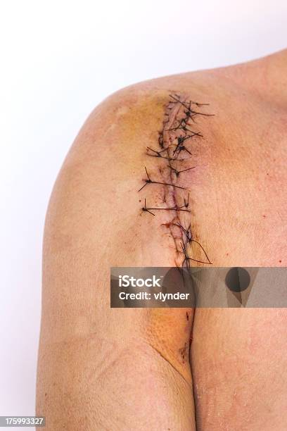 Foto de Stiched Scar No Ombro e mais fotos de stock de Articulação humana - Articulação humana, Clavícula, Corpo humano