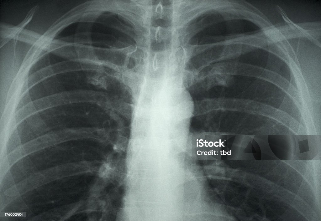 Radiografía de tórax - Foto de stock de Asistencia sanitaria y medicina libre de derechos