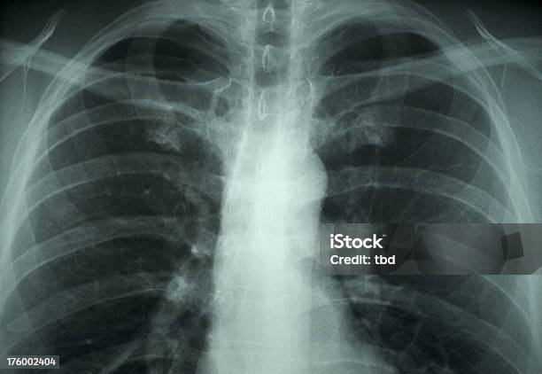 Radiografía De Tórax Foto de stock y más banco de imágenes de Asistencia sanitaria y medicina - Asistencia sanitaria y medicina, Belleza, Caja torácica humana