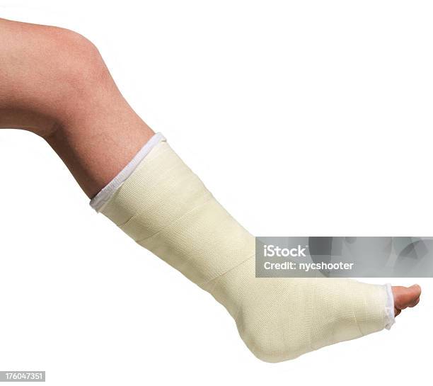 Broken Fuß In Gusseisen Stockfoto und mehr Bilder von Gipsverband - Gipsverband, Gebrochenes Bein, Funktionsuntüchtig