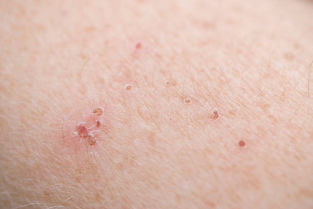 istock Skin condition close-up, red scars 176054028