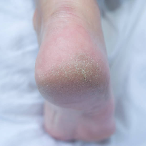 istock Dry heel on white background, close-up skin condition concept 176054301