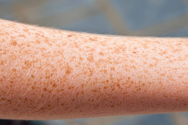 close up of freckled sun sensitive skin on limb close up colour horizontal image of an arm showing very freckled skin with a fair complexion. Young adult. Blond skin hair. Freckles are due to an increase in melanin. Increased sun sensitivity.Taken outdoors. freckle photos stock pictures, royalty-free photos & images