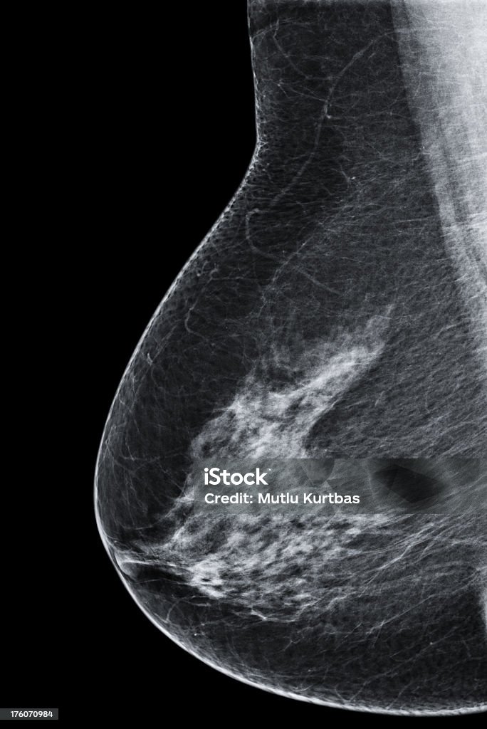 게자리 유방 유방조영상 1회 - 로열티 프리 유방 촬영술 스톡 사진