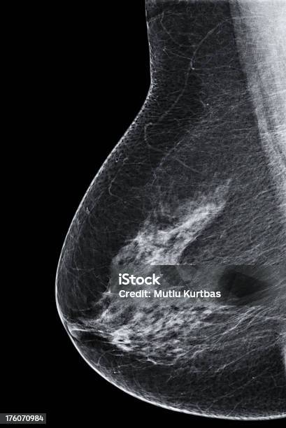 게자리 유방 유방조영상 1회 유방 촬영술에 대한 스톡 사진 및 기타 이미지 - 유방 촬영술, 유방, X-레이