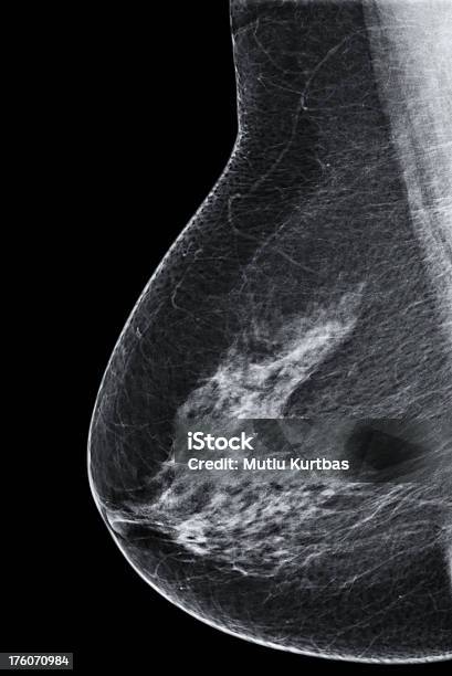 Rak Piersi Mammografia - zdjęcia stockowe i więcej obrazów Mammografia - Mammografia, Pierś, Badania